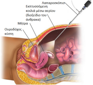 Εικόνα λαπαροσκόπησης