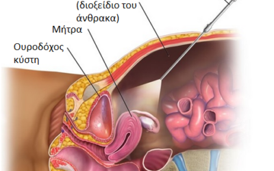 Ινομυώματα μήτρας