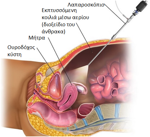 Εικόνα λαπαροσκόπησης