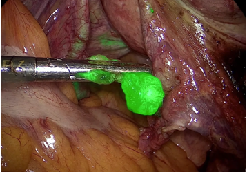 Καρκίνος ενδομητρίου και αφαίρεση φρουρών λεμφαδένων μέσω NIR/ICG